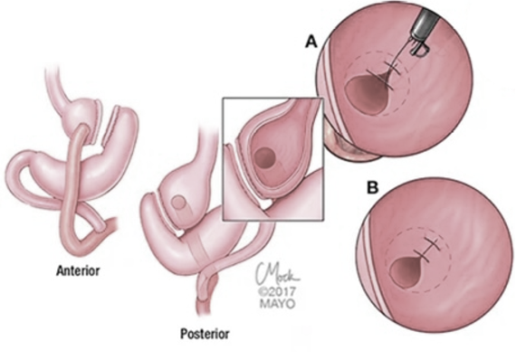 Medizinische Illustration eines Anastomosenverschlusses nach Magenbypass-Operation in anteriorer und posteriorer Ansicht.