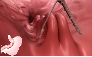 Endoskopische Darstellung einer Magenoperation mit chirurgischen Instrumenten, schematische Magenzeichnung unten links.