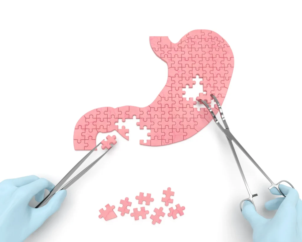 Puzzleteile in Form eines Magens, mit Zangen von behandschuhten Händen bewegt, symbolisieren chirurgische Präzision.