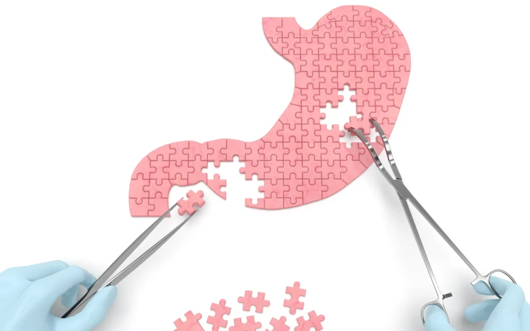 Puzzleteile in Form eines Magens, mit Zangen von behandschuhten Händen bewegt, symbolisieren chirurgische Präzision.