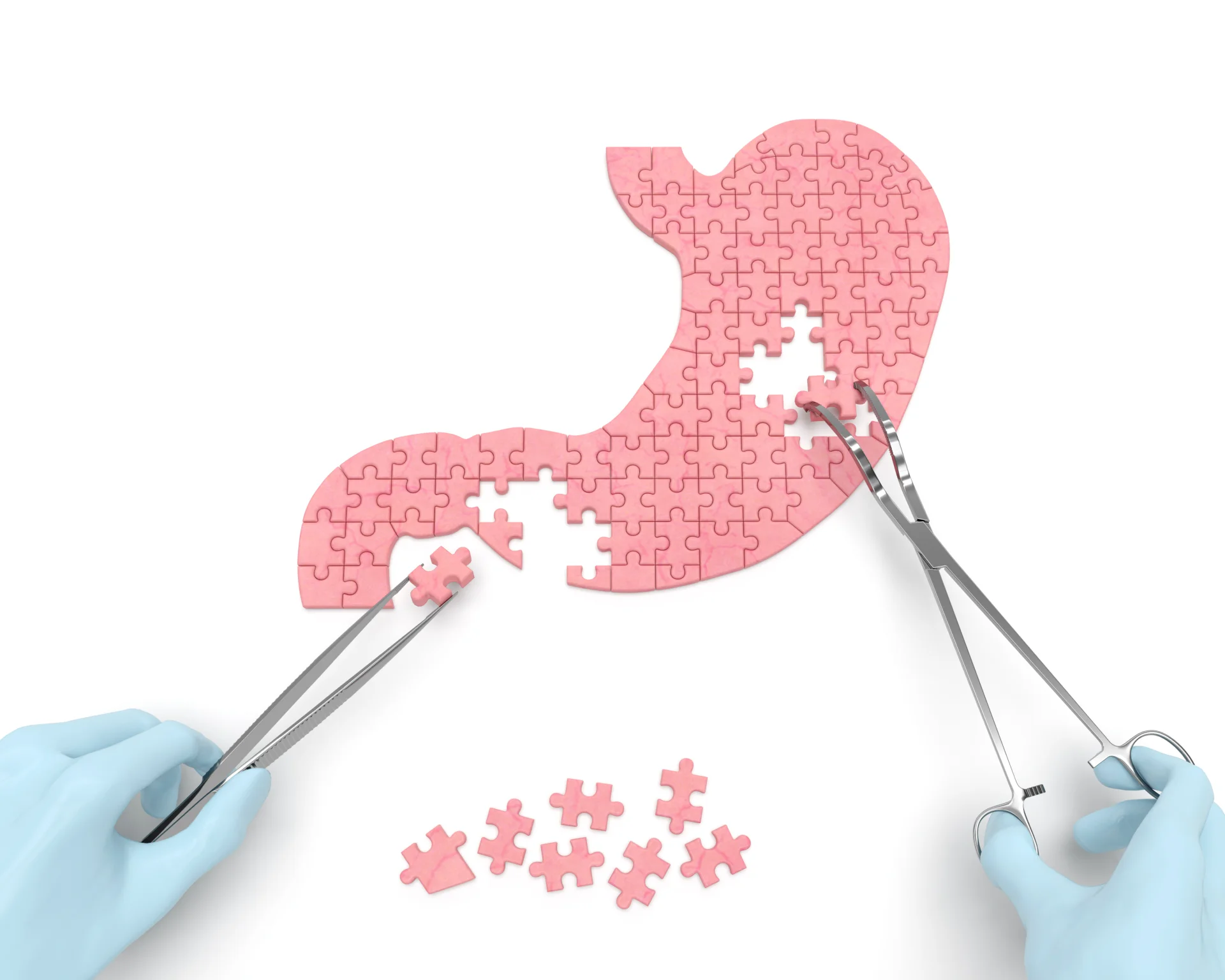 Puzzleteile in Form eines Magens, mit Zangen von behandschuhten Händen bewegt, symbolisieren chirurgische Präzision.